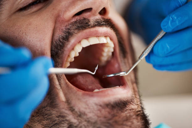 Best Wisdom Tooth Removal  in Gates Mills, OH